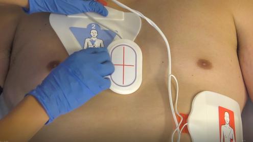 Anteroposterior placement of aed pads adults Escorts in windsor canada