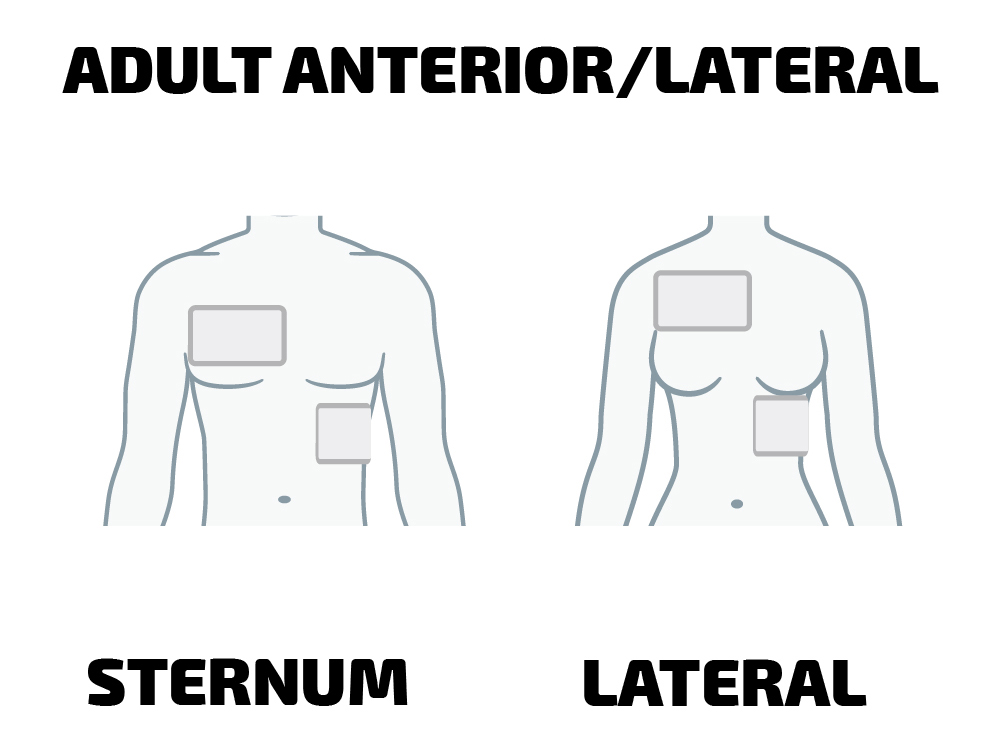 Anteroposterior placement of aed pads adults Glitch porn