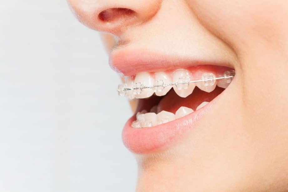Best teeth braces for adults Adult store hagerstown md
