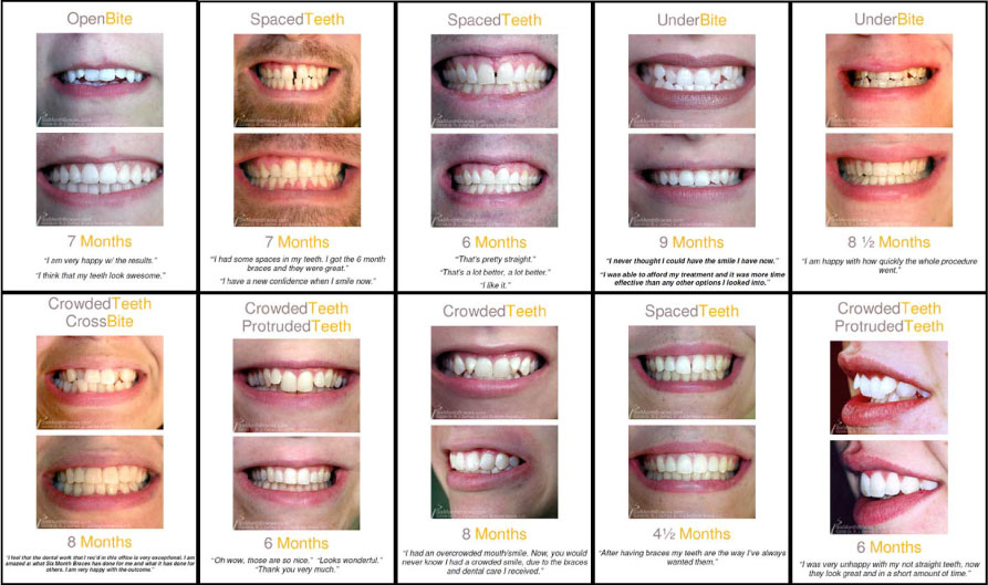 Best teeth braces for adults Sister with strapon