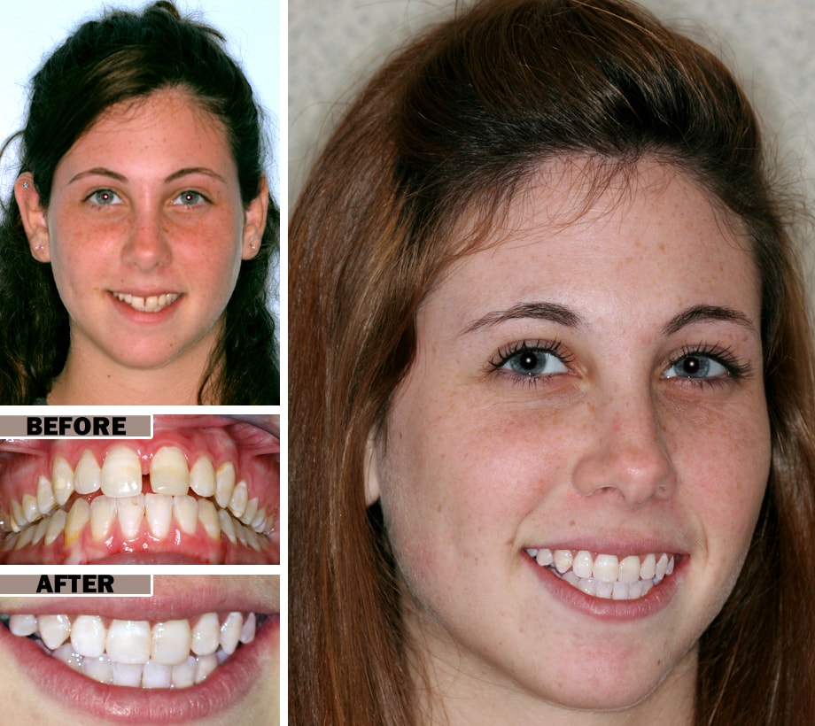 Best teeth braces for adults Webcam from walmart
