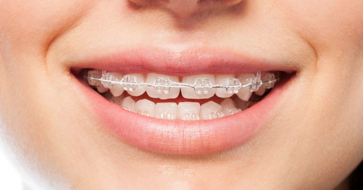 Best teeth braces for adults Harper rose escort