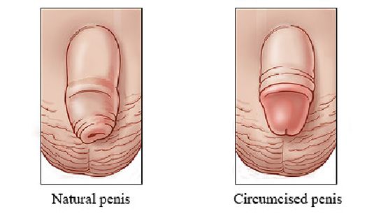 Circumcision for adults near me Karol g porno