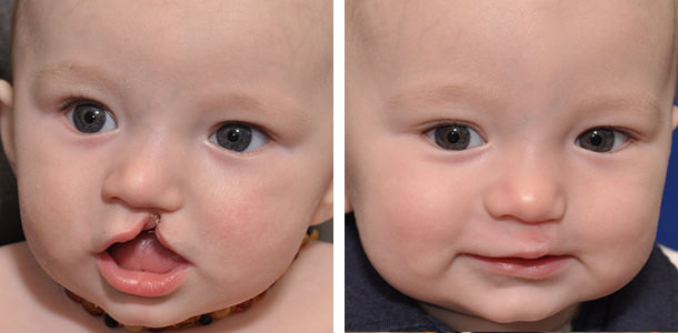 Cleft lip and palate adults Escort 11385