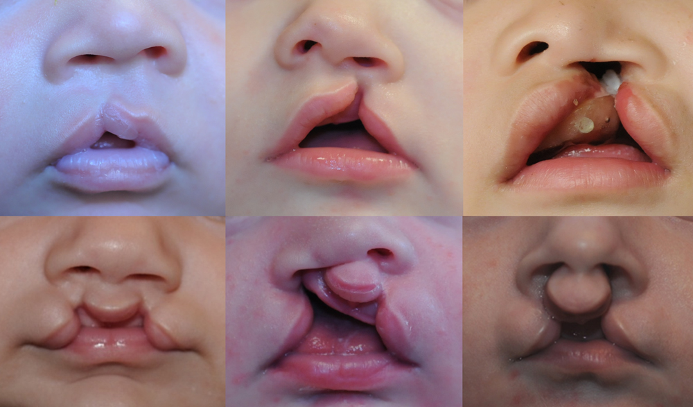 Cleft lip and palate adults Ana maxi porn