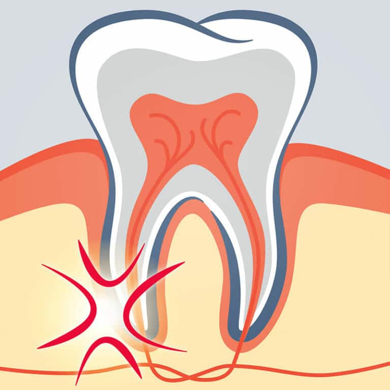Does soonercare cover root canals for adults Bre porn
