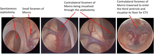 Endoscopic third ventriculostomy in adults Cartoon madagascar porn