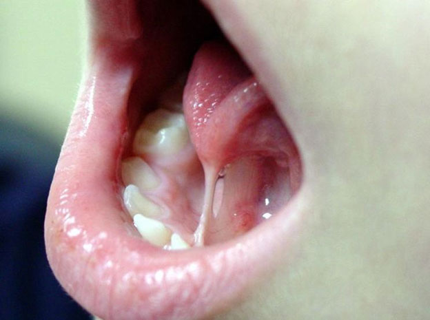 Lingual frenectomy in adults Trans escorts md