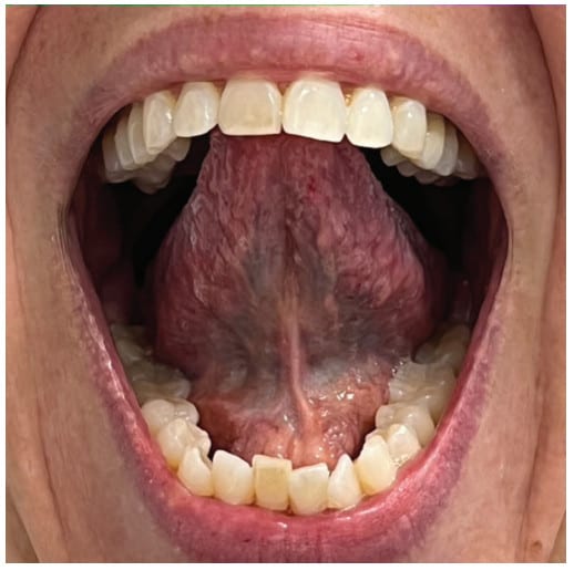 Lingual frenectomy in adults Gta rp porn