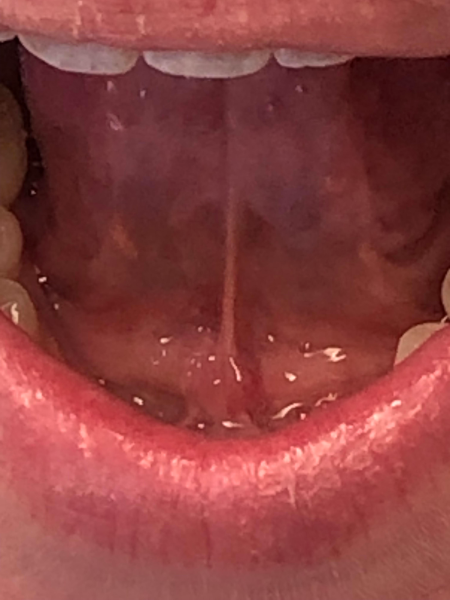 Lingual frenectomy in adults Realminitinah porn