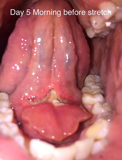 Lingual frenectomy in adults Extreme streets porn full