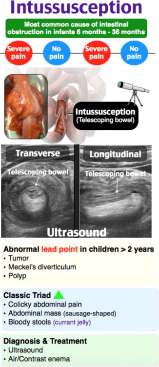 Most common site of intussusception in adults Daddy fingers me porn