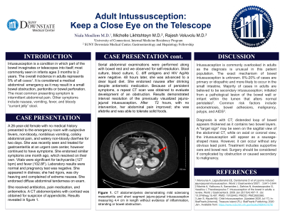 Most common site of intussusception in adults Black owned cuckold