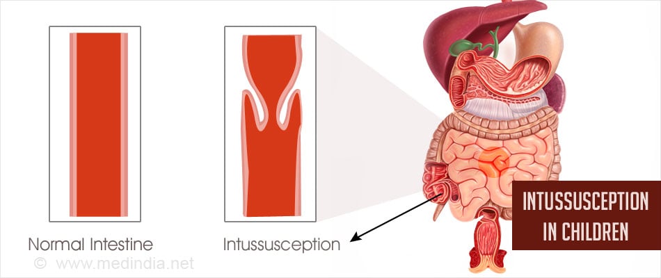 Most common site of intussusception in adults Bound slave porn