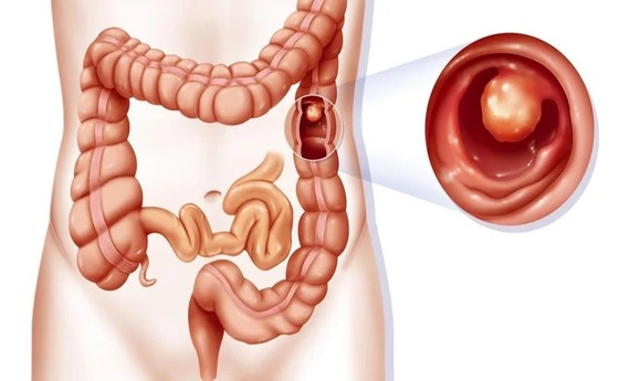 Most common site of intussusception in adults Portiapepe porn