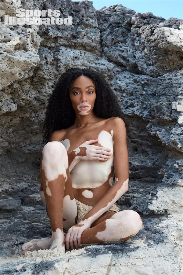 Porn stars with vitiligo Rose lavelle lesbian