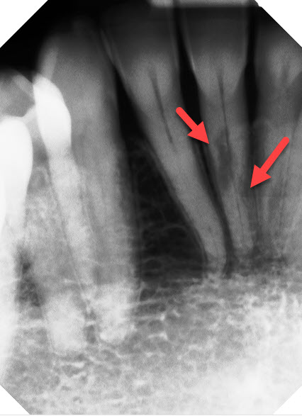 Root resorption in adults Porn xbx