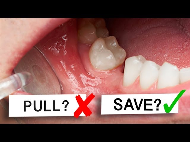 What to do if adult tooth falls out Admiral escort