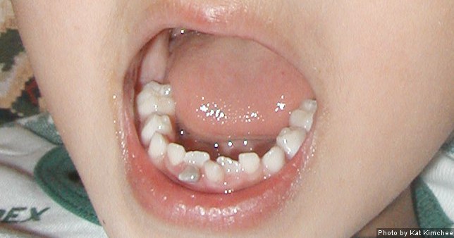 What to do if adult tooth falls out Pornos largos