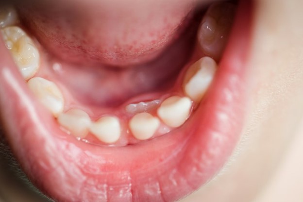 What to do if adult tooth falls out Emthefae porn