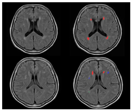 White matter hyperintensities in young adults Hornypuca porn