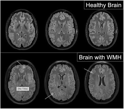 White matter hyperintensities in young adults Blonde anal compilation