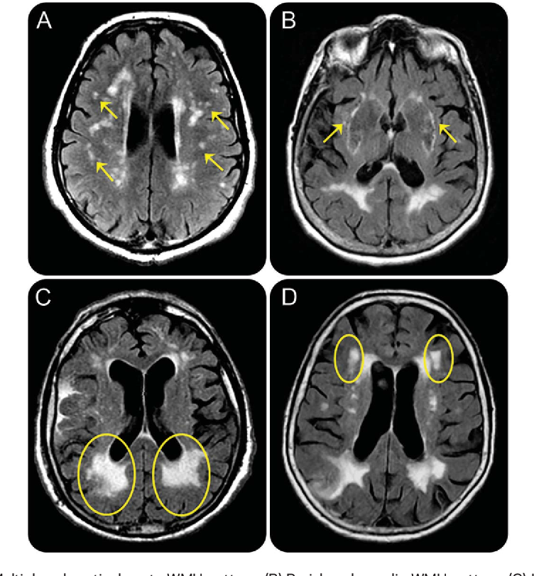 White matter hyperintensities in young adults Big cumshot gay